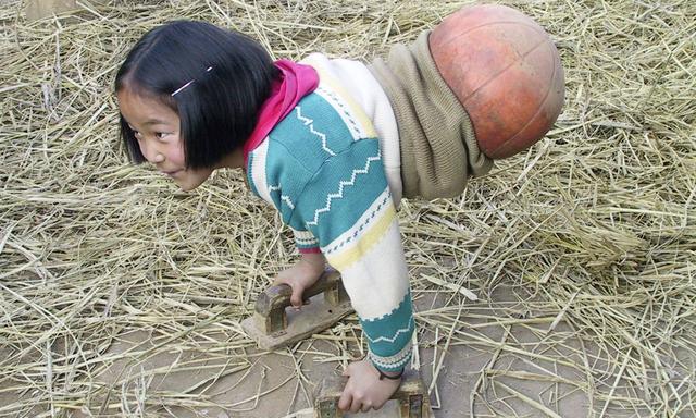 小女孩车祸失去双腿图片