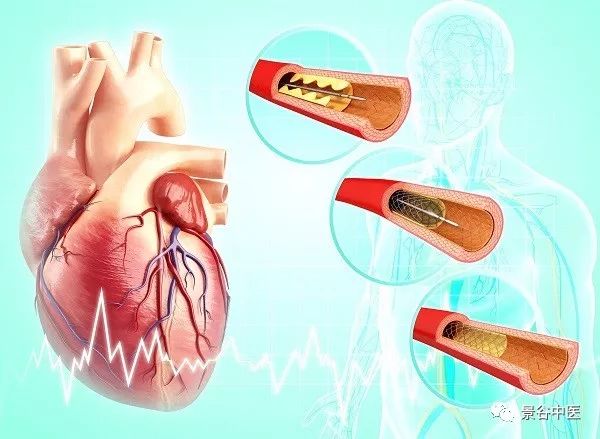 景谷中醫動態首例急性st段抬高型心肌梗死靜脈溶栓成功