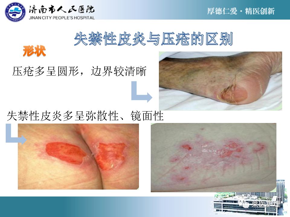 ppt老年失禁性皮炎的护理