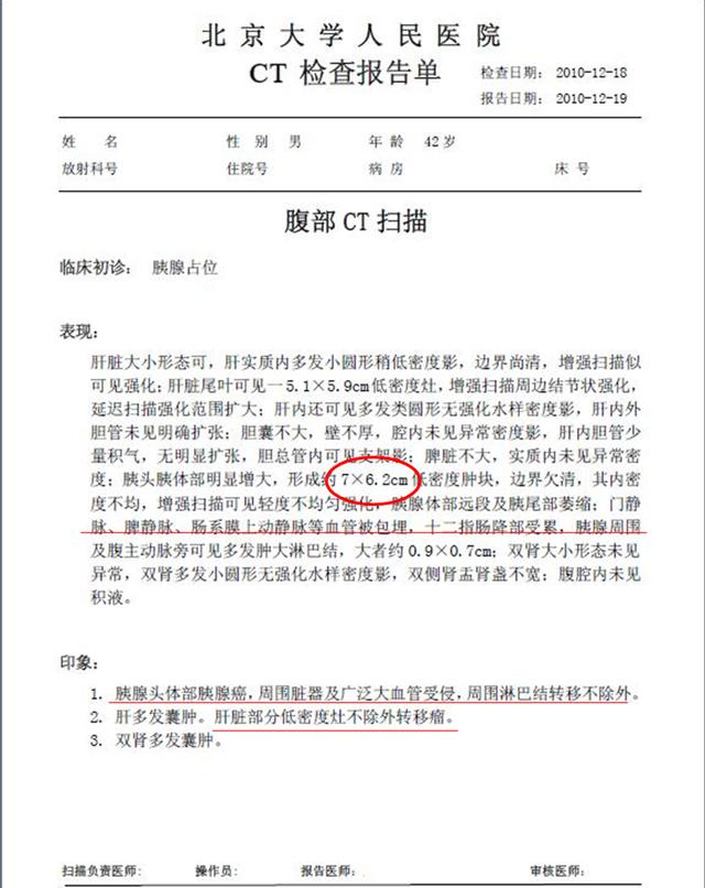 胰腺癌的ct图片与报告图片