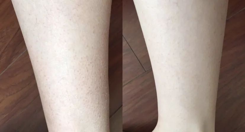 同时,在运动瘦腿的过程中,可以避免肌肤松弛,消除橘皮.