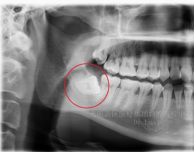 5)牙源性囊腫,腫瘤:長期的炎症,壓迫周圍組織可能導致頜骨囊腫,牙源性