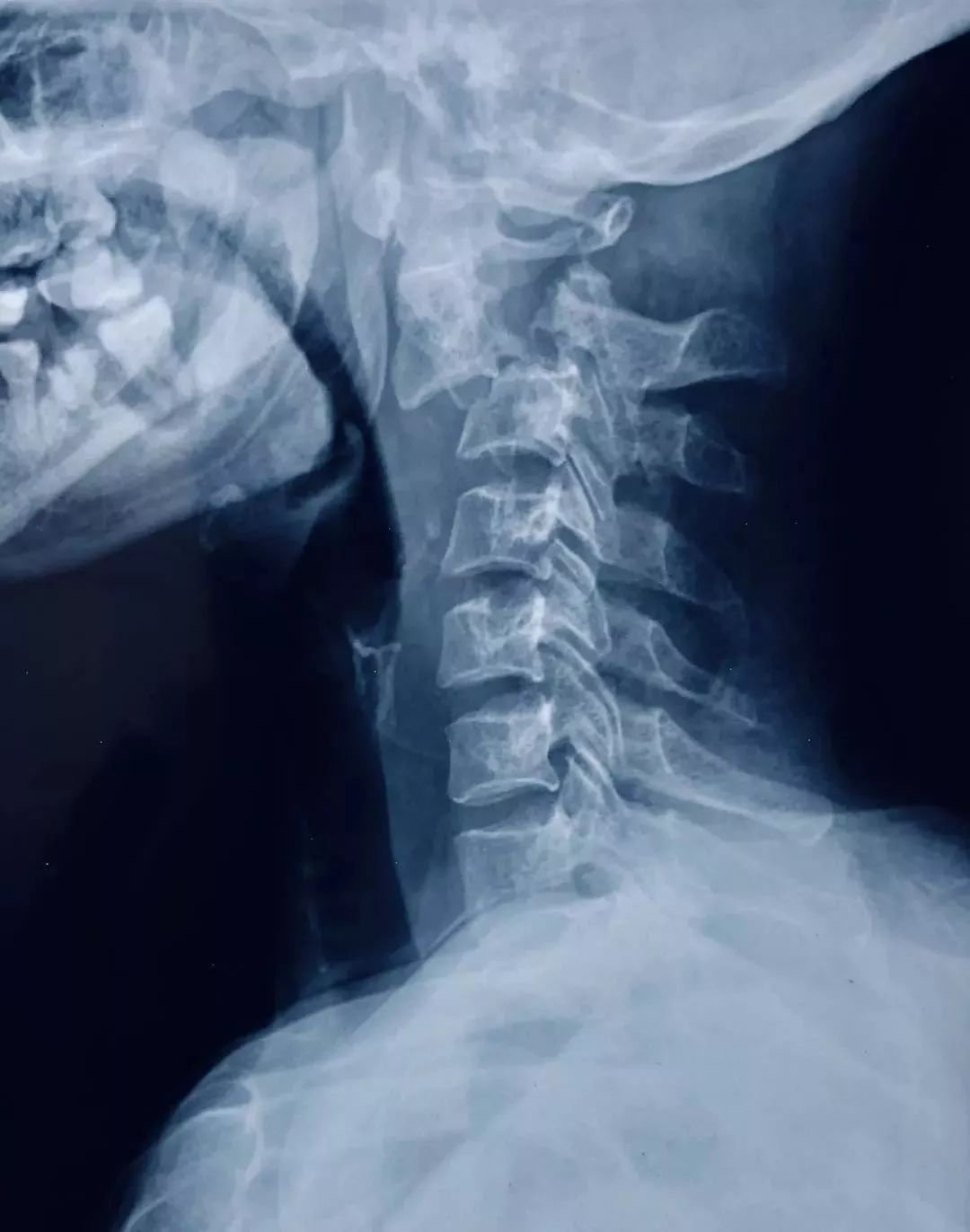比如:如果检查颈椎,颈椎正侧位,是最常见的检查,通过它,能对颈椎有个
