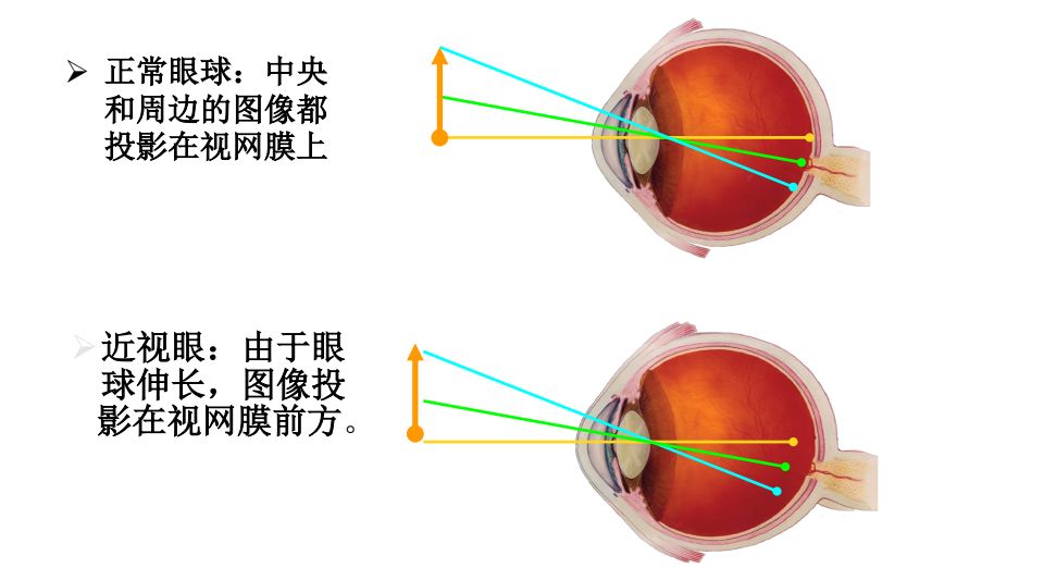 控制近视新突破可控59到底是什么产品