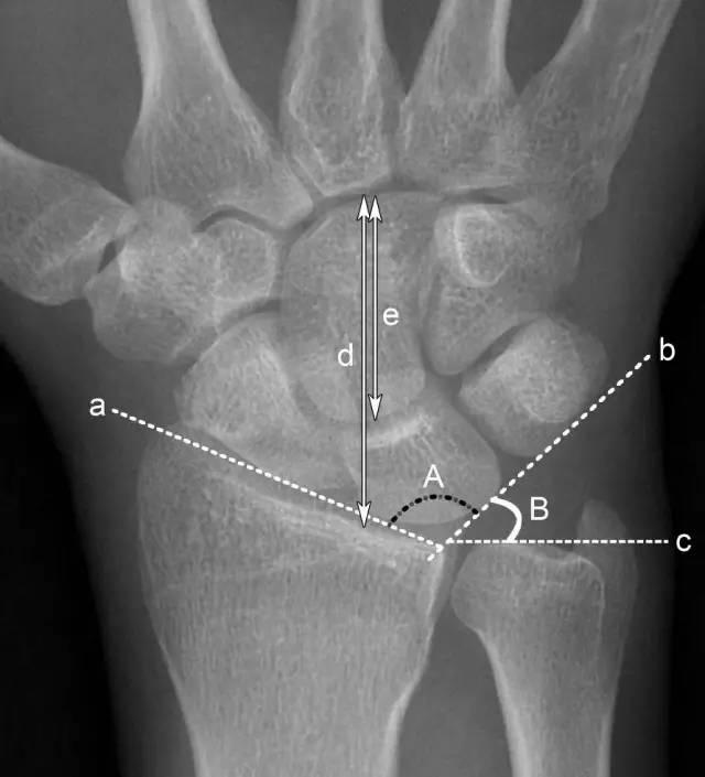 「临床实用」腕关节x线阅片技巧,建议收藏
