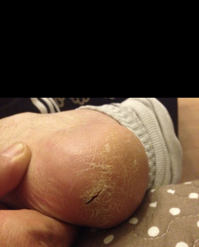 尿素乳膏手护妈妈