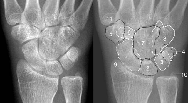 「临床实用」腕关节x线阅片技巧,建议收藏