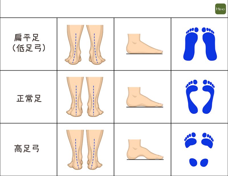 小孩扁平足图片 判断图片