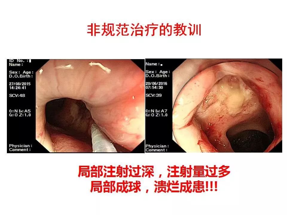 教学ppt内痔的内镜下硬化治疗经验分享