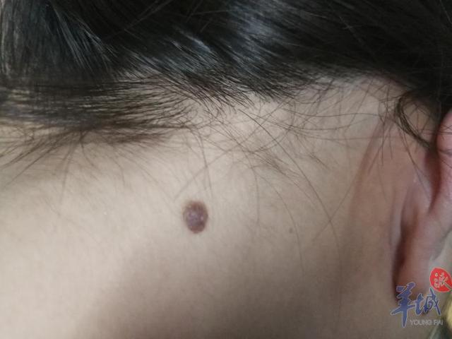 黑痣就是恶性黑色素瘤 别吓自己 曹洋