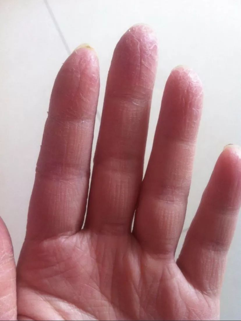 major snow 这样一个普遍度极高的皮肤疾病,我们是否有合适的药膏来