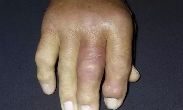 排出尿酸远离痛风医生说喝2种水就够了