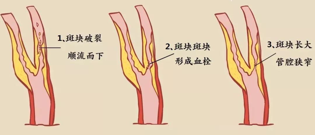 颈动脉狭窄程度图片