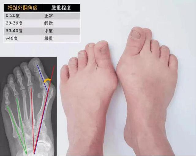 什么是拇趾外翻?该怎么办?_脚趾