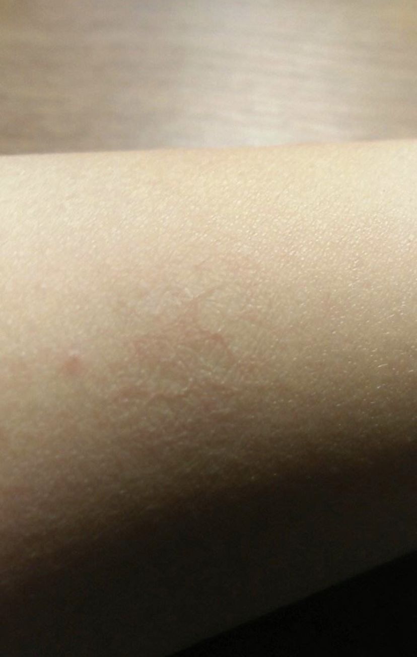 major snow这样一个普遍度极高的皮肤疾病,我们是否有合适的药膏来