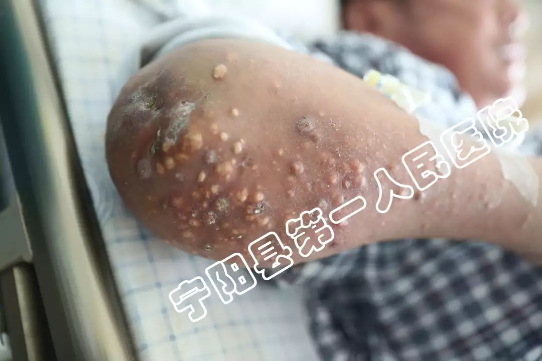 震惊10年间全身长满石头医生10条提示远离痛风石