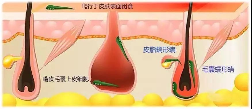 我國蠕形蟎瞼緣炎診斷和治療專家共識2018年