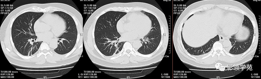 有关肺挫伤的影像表现