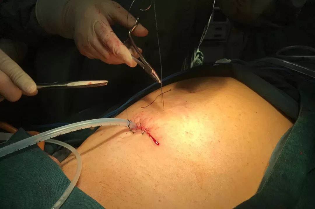 对于前列腺癌来说,由于前列腺位于盆腔的最深处,周围血管极其丰富