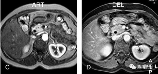 冠狀t2wi,mrcp,軸位t2wi示膽總管下段腔內兩枚結石,呈低信號充盈缺損