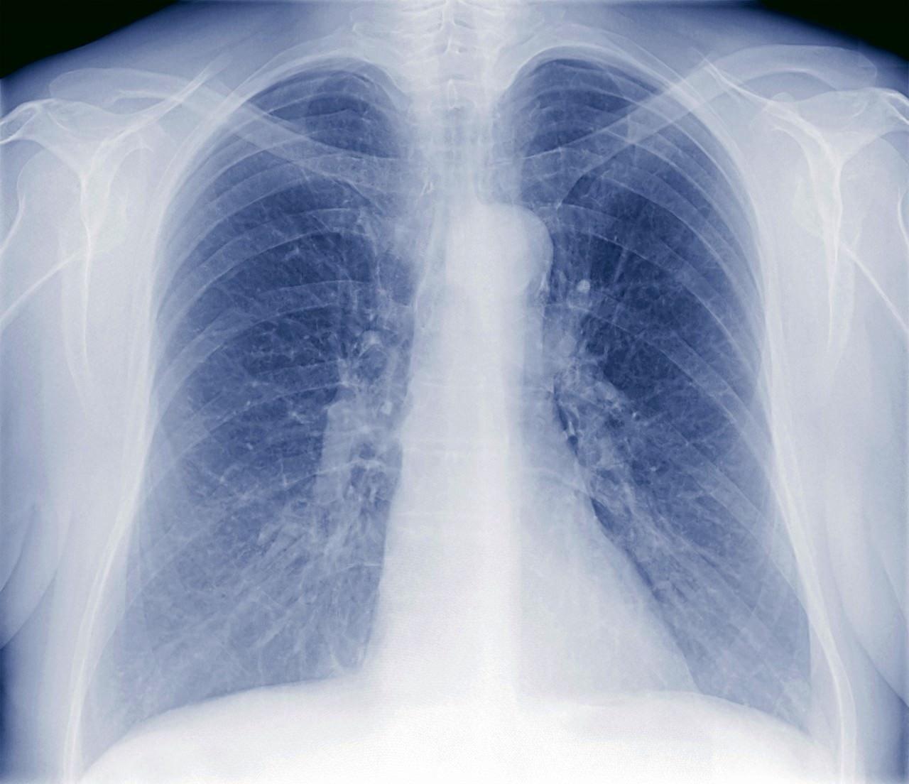 正常肺和肺结核图片图片