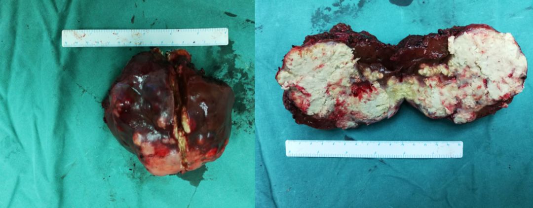 結腸癌術後伴肝轉移行d-tace治療一例