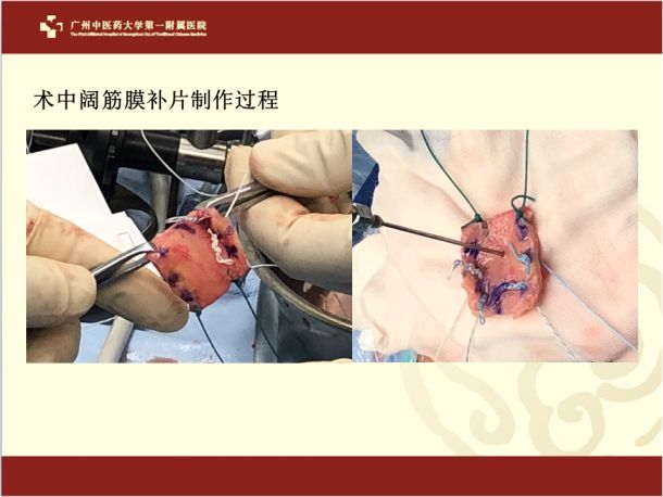 筋骨堂巨大肩袖損傷的關節鏡下補片橋接修復治療