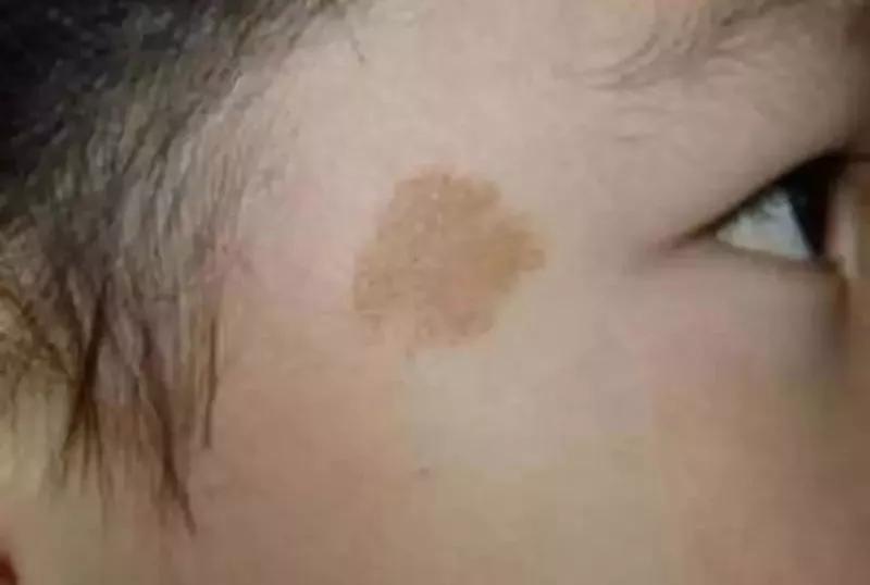 血管型则包括葡萄酒色斑,草莓样血管瘤等;胎记一般分为色素型及血管型