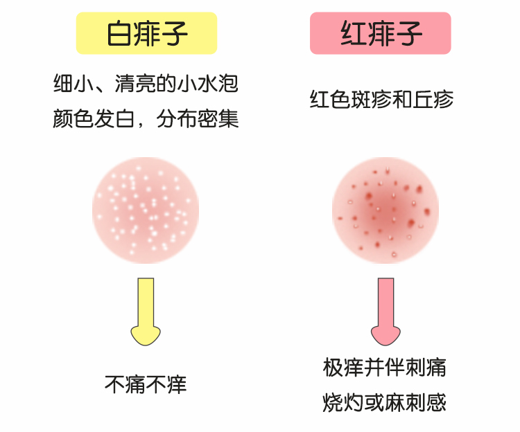 红痱子:表现为分散分布的红色斑疹和丘疹,极痒并伴刺痛,烧灼或麻刺感.