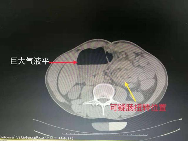 后行ct检查提示:左中腹部肠管,系膜及血管纠集伴漩涡征,考虑肠扭转