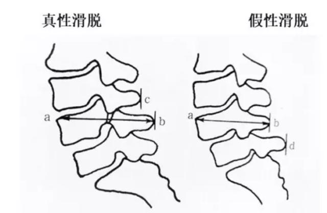 什么是腰椎真滑脱?什么是假滑脱?怎么解决?