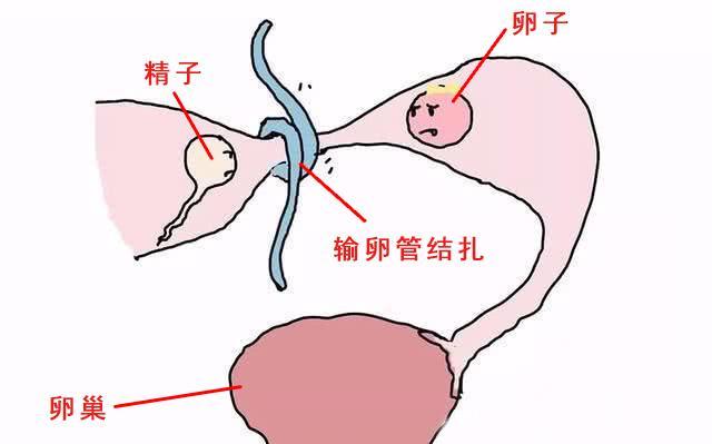 女性结扎开腹 输卵管图片