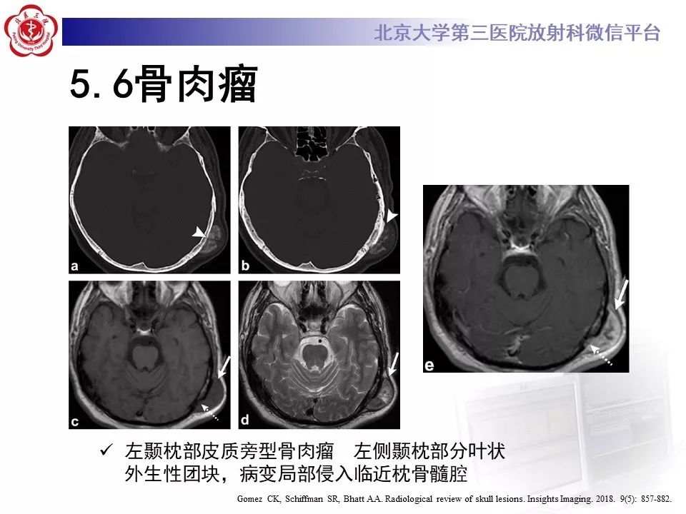 颅骨嗜酸性肉芽肿图片