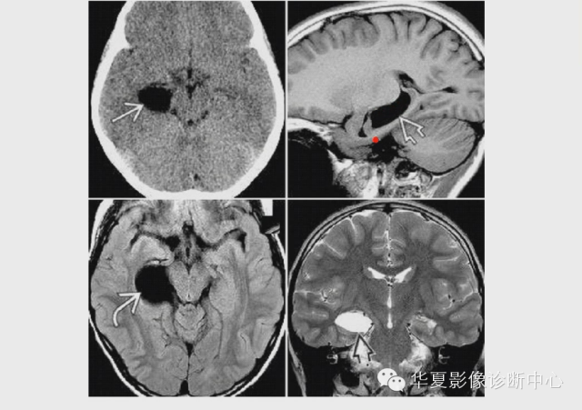 写影像报告你应该知道的颅内15种原发性囊肿含诊断思路