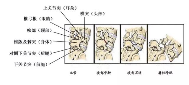 腰椎斜位片狗头征象图片