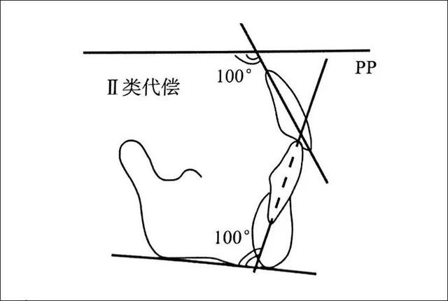 轻度的ii类骨骼,通过调整上下前牙的转矩角度,可以实现上下前牙正常的