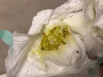 从图片上来看,宝宝的大便有绿有黄色的,绿色部分比较稀,基本被尿不湿