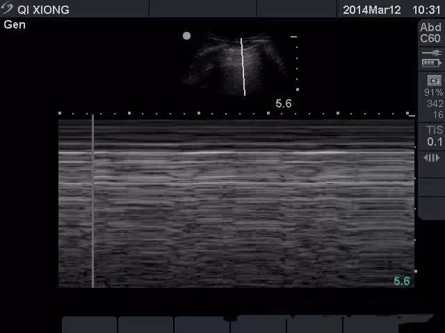 实用技能超声诊断气胸