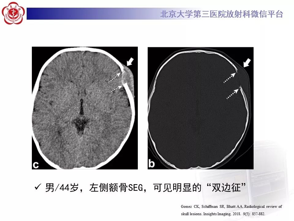 颅骨嗜酸性肉芽肿图片