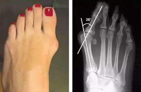 拇外翻(大脚骨)和足弓有密不可分的关系,矫正拇外翻一定要恢复足弓的