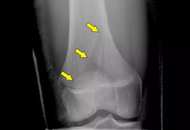 青少年运动中发生骨折不要怕 美国博士教你如何处理 损伤