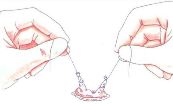 女性结扎好还是男性结扎好?是时候明确一下答案了