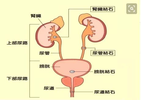 泌尿系结石的患病率竟有这么高?每位男性都该知道!