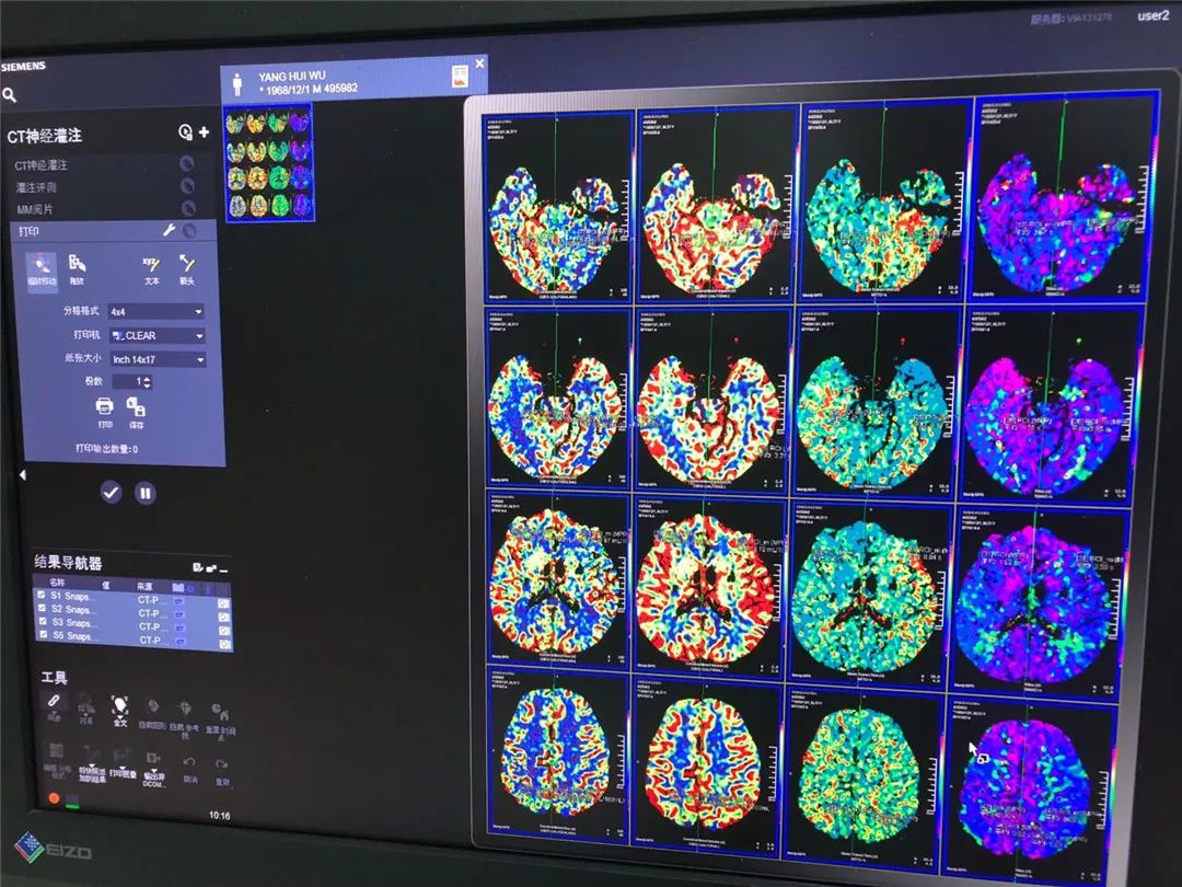 【请您关注】总院云影像中心顺利开展ct脑灌注成像检查