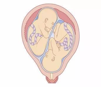 原创同卵双胞胎只有一个胎心怎么办呢?