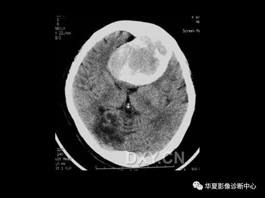 儿童颅骨骨瘤图片图片