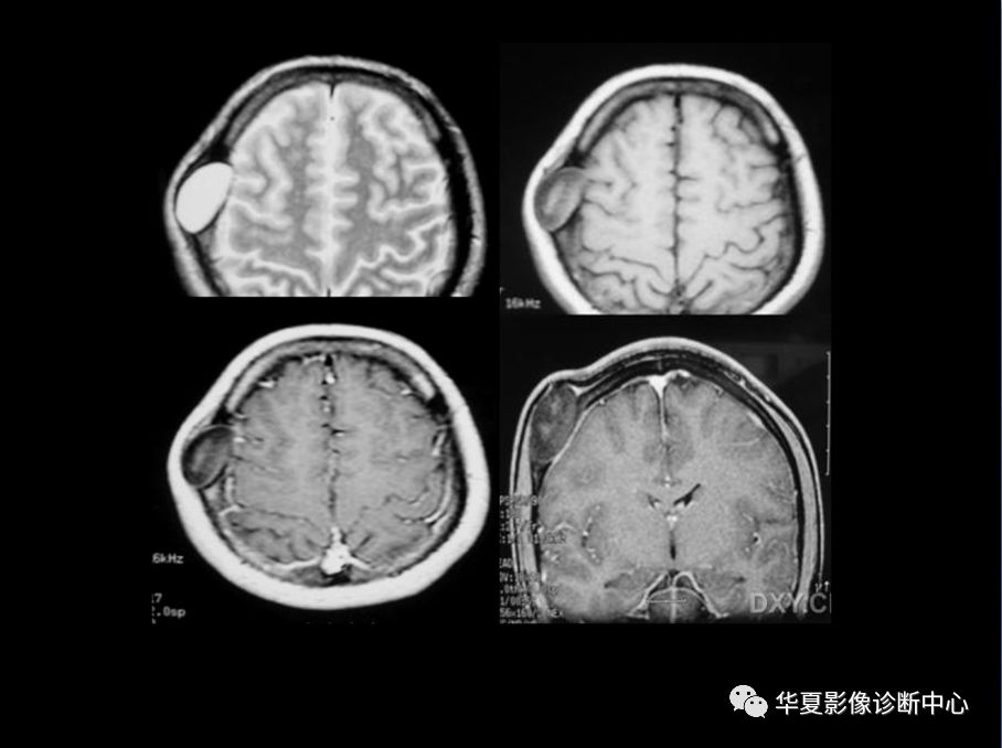 颅骨良性肿瘤的影像诊断