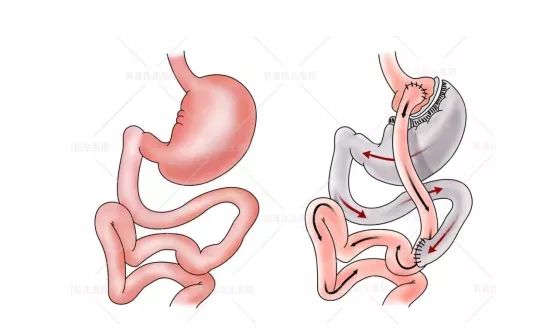 糖尿病患者的尿真是甜的原来这才是糖尿病跟糖之间的关系