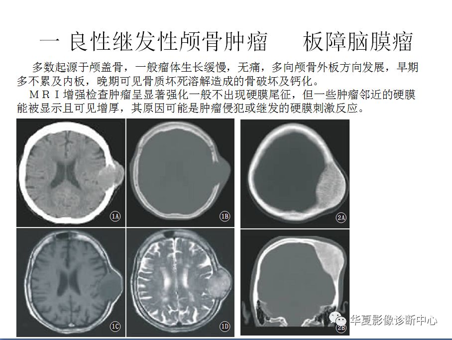 颅骨良性肿瘤的影像诊断