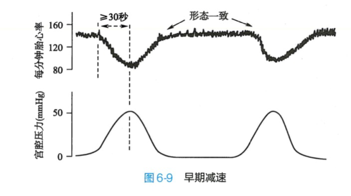 胎监减速图片